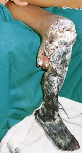 Plik:Tissue necrosis following bite from Bothrops asper PLoS Medicine.jpg
