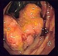 Colorectal cancer endo 2.jpg